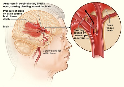 Vitamina C previne atacul cerebral